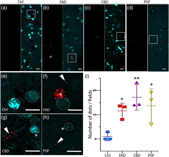 In situ PLA on human brain tissue confirms colocalization between hyperphosphorylated tau (AT8) and LC3. a-d The white signal shows the PLA dots in healthy controls and patients, respectively. In merged pictures, PLA staining (red) and DAPI (blue) are shown in FAD, CBD and PSP. PLA dots are rarely observed in control individuals. e-h High magnification of the boxed area from the merged pictures. Asterisks show PLA signal close to the nucleus (white dashed line), and arrowheads indicate PLA signal distant from clearly visible cell soma in FAD, CBD and PSP patients. Scale: 10 μm. i In the graphs PLA signal (number of dots/field) are indicated as Mean value ± S.D. from healthy controls and patients