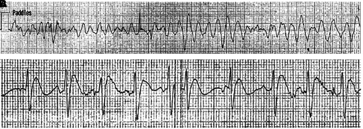 (A) Polymorphic ventricular tachycardia and (B) Type-1 Brugada pattern.