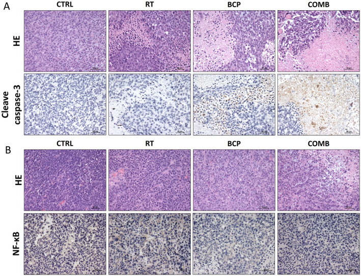 The combination treatment significantly increased cleaved caspase‐3 levels and suppressed NF‐κB expression in tumors harvested on day 19 as detected using IHC. (A) The images of hematoxylin and eosin (HE) staining, along with cleaved caspase‐3 and (B) NF‐κB staining in different groups, are presented in the figure. The scale bar = 50 μm.