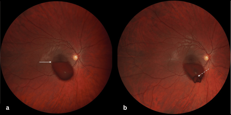 Premacular Subhyaloid Hemorrhage Before and After Nd:YAG Laser HyaloidotomyColor fundus photographs (ZEISS Clarus 700) of the right eye showing a premacular subhyaloid hemorrhage before treatment (a) and after Nd:YAG laser hyaloidotomy (b). The hemorrhage is oval-shaped, centered on the macula, and measures approximately seven-disc diameters, with inferior extension beyond the inferior vascular arcade. A horizontal fluid–fluid level is visible (solid arrow), with a dense inferior red layer obscuring the underlying retina and a more translucent superior layer allowing partial visualization of the retinal structures. Laser energy was progressively increased, and successful posterior hyaloid perforation was achieved at 10 mJ, allowing drainage of the hemorrhage into the vitreous cavity (dashed arrow).