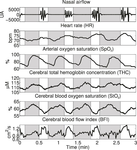 Nasal airflow, heart rate, arterial oxygen saturation, total hemoglobin concentration, cerebral blood oxygen saturation and blood flow index dynamics for three minutes of night sleep for one representative obstructive sleep apnea subject. See the text for details. The gray regions between two vertical lines indicate obstructive apneic events.