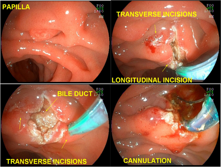 EFP with lateral incisions. a papilla of difficult cannulation with the guide wire; b wide longitudinal incision and lateral incisions; c exposure of the submucosa by pushing aside the mucosal edges, sectioning the musculature fibers until opening the common bile duct; d deep cannulation of the bile duct