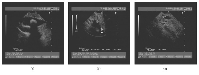 The diameter of common bile duct stones measured on linear endoscopic ultrasound. (a) >1 cm, (b) 0.5–1.0 cm, and (c) <0.5 cm.