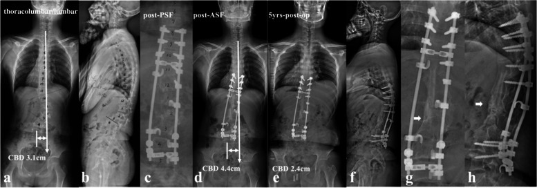 an 11-year-old boy with NF1 related lumbar kyphoscoliosis associated with CCI (lumbar type) (a, b); Stage 1 posterior spinal correction and fusion surgery using hybrid implants (screws and hooks) was performed with low screw density at apical region (c), followed by stage 2 supplementary anterior intervertebral fusion utilizing structural fibular allograft (d). Over correction of upper hemi curve resulted in aggravation of CCI (4.4 cm). The patient experienced spontaneous improvement of CBD at 5 years follow-up (e). Despite low implant density, no implant failure occurred because the fusion of the anterior column was good (f, g, h)