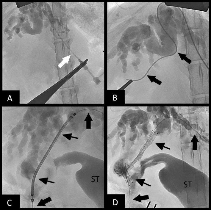 Fluoroscopic images of transhepatic biliary rendezvous technique performed in Case 2. (A)—Fluoroscopic study showing the catheter (white arrow) within the intrahepatic duct, with a successful cholangiogram performed. (B)—Passage of the hydrophilic guidewire (thick black arrows) through the CBD and into the duodenum. (C)—Passage of the biliary stent delivery system (thin black arrows) over the wire. Contrast filling of the stomach (ST) is noted after filling the stent delivery system with contract to document the duodenal lumen location on fluoroscopic imaging for distant stent placement. (D)—Cholangiogram showing patency of the deployed biliary stent (thin black arrows).