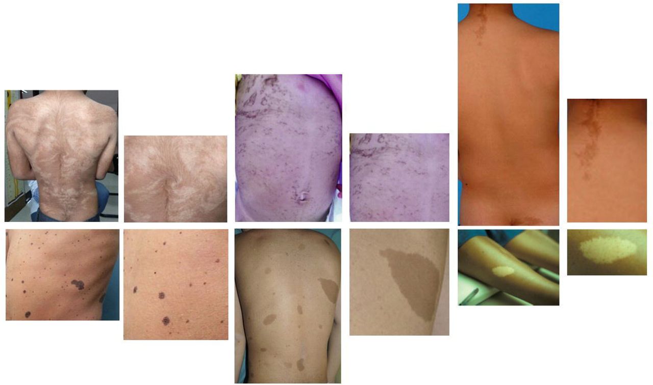 Example panoramic and focused images for each pair of conditions. Top row, from left to right: Hypomelanosis of Ito (HMI), Incontinentia Pigmenti (IP), McCune-Albright Syndrome (MA). Bottom row, from left to right: Neurofibromatosis Type 1 (NF1), Noonan Syndrome with Multiple Lentigines (ML; formally known as LEOPARD syndrome), Tuberous sclerosis Complex (TSC). See Supplemental Table 1 for more details on these conditions. Image sources (all used with appropriate permissions; see Supplemental data for permissions):HMI: https://casereports.bmj.com/content/12/4/e227693;IP: https://www.researchgate.net/figure/X-linked-Incontinentia-pigmenti-Pattern-type-1a-Blaschko-lines-narrow-bands_fig3_257074473;MA: https://www.researchgate.net/figure/Representative-Cafe-au-lait-Spots-Seen-in-McCune-Albright-Syndrome-A-spectrum-of-spots_fig4_225077911;ML: https://pmj.bmj.com/content/94/1116/605;NF1: https://www.sciencedirect.com/science/article/pii/S1578219016300853;TSC: https://www.sciencedirect.com/science/article/pii/B9780444627025000068?via%3Dihub