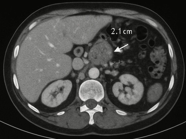 CT abdomen revealing soft tissue swelling in the head of the pancreas with peripancreatic lymphadenopathyThe white arrow indicates the soft tissue swelling with its size of 2.1 cm.CT: computerized tomography