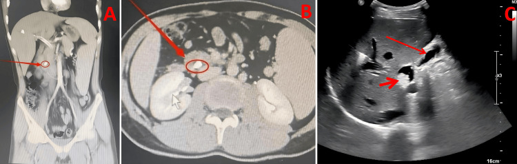 Findings from abdominal imaging examinations.Abdominal computed tomography image indicates a high-density stone shadow in the common bile duct (CBD) duodenal segment. The arrow in (A) depicts a sagittal section of the abdominal computed tomography scan, while that in (B) shows the transverse section. (C) Abdominal ultrasonography demonstrated mild intrahepatic biliary dilation (approx. 0.8 cm) (long arrow) and a hyperechoic mass measuring 1.7 × 1.5 cm with posterior acoustic shadowing in the distal CBD (short arrow).
