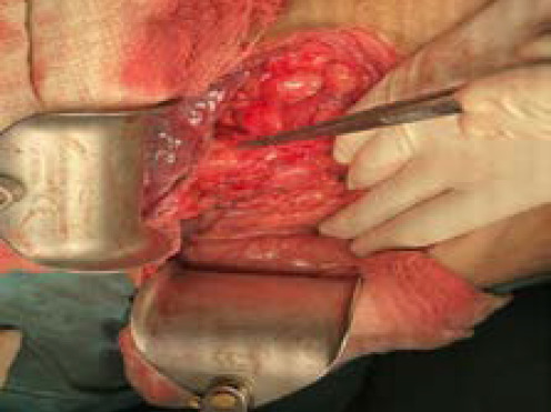 Demonstration of dilated Common bile duct
