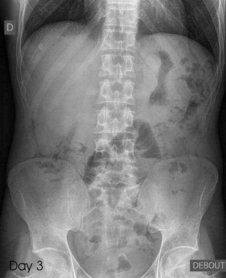 Plain abdominal X-ray after 3 days