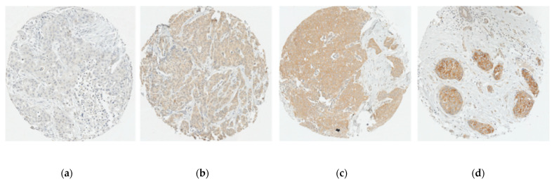 Representative immunostaining of tumour cores for CBR1: Cannabinoid receptor 1 expression intensity scores; (a) 0 (none); (b) 1 (weak); (c) 2 (moderate); (d) 3 (strong). Scale: 10X.