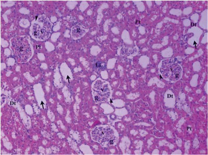 Renal tissue in diabetic ischemia reperfusion group (Group DM-I/R). Pt: Proximal tubule, Dt: Distal tubule, v: vacuolar, Li: lymphoid infiltration, g: glomerulus, arrow head: bowman space, arrow: dilated tubule (H&EX10).