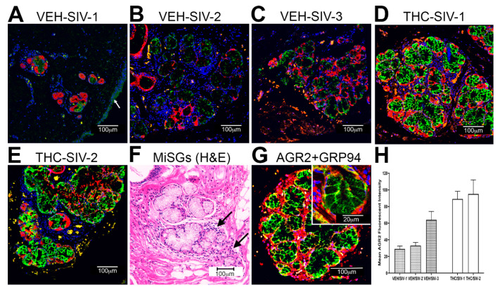 Chronic THC administration preserves AGR2 protein expression in the minor salivary glands (MiSGs) of chronically SIV-infected rhesus macaques (A–E) Triple labels with AGR2, cytokeratin (red) and Topro3 (blue) for nuclear staining. Note the significantly decreased AGR2 (A–C) staining in the MiSGs of VEH/SIV rhesus macaques. In contrast, AGR2 (D,E) staining is intense in the MiSGs of THC/SIV rhesus macaques. All panels are 40× magnification. An H&E image of OPM tissue from a VEH/SIV rhesus macaque (F) shows mild to moderate lymphoplasmacytic infiltration (black arrows) of MiSGs suggesting sialadenitis. (G) Triple labels with AGR2, endoplasmic reticulum marker GRP94 (red) and Topro3 (blue) for nuclear staining. Yellow staining in (G) (inset) indicates localization of AGR2 to the endoplasmic reticulum. Quantification of cells and regions of interest (ROI) labeled by AGR2 (H) was performed using Volocity 5.5 software after capturing images on a Leica confocal microscope. Several ROI were hand drawn on the MiSGs and their ductal regions in the images from the three VEH/SIV and two THC/SIV rhesus macaques. The mean fluorescent intensity data are represented as mean ± standard deviation for each animal.