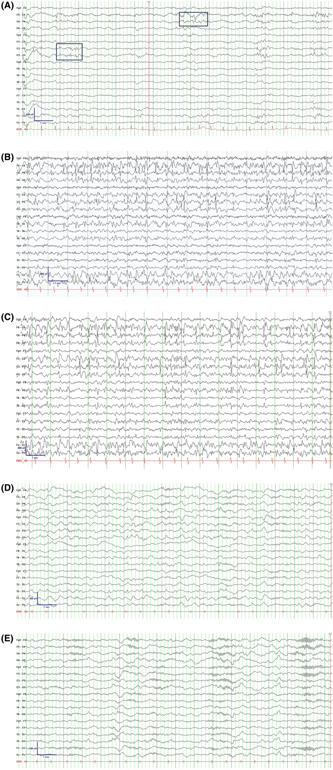 Evolution of sleep (N1/N2) EEG patterns over time in DEE‐SWAS. For all EEG tracings: Low frequency filter = .5 Hz and High frequency filter = 70 Hz. (A) Age 2.5 years: New‐onset focal seizures. Occasional spikes and sharp waves in the bilateral centroparietal regions during sleep (e.g., highlighted in boxes). Routine EEG; Longitudinal bipolar montage; paper speed 30 mm/s. Medications: None. (B) Age 3.5 years: Nearly continuous 1.5–2 Hz bilateral centrotemporal–parietal spike‐and‐wave complexes in non‐rapid eye movement sleep, associated with developmental regression. Ambulatory EEG; Longitudinal bipolar montage; paper speed 30 mm/s. Medications: Clobazam (1 mg/kg) and sulthiame (20 mg/kg). (C) Age 9 years: Persistent, nearly continuous 1.5–2 Hz bilateral centrotemporal–parietal spike‐and‐wave complexes in non‐rapid eye movement sleep, associated with minimal developmental gains. Ambulatory EEG; Longitudinal bipolar montage; paper speed 30 mm/s. Medications: Valproic acid (25 mg/kg) and lamotrigine (3 mg/kg). (D) Age 9.5 years: Cannabidiol initiated. No epileptiform discharges during sleep, with re‐emergence of sleep spindles. Findings indicate resolution of DEE‐SWAS, accompanied by parent reported developmental improvement. Ambulatory EEG; longitudinal bipolar montage; paper speed 30 mm/s. Medications: Cannabidiol (10 mg/kg), valproic acid (25 mg/kg), and lamotrigine (3 mg/kg). (E) Age 10.5 years: Continued therapy with cannabidiol, valproic acid, and lamotrigine. No epileptiform discharges during sleep, with preserved sleep spindles and vertex waves. Sustained resolution of DEE‐SWAS with ongoing developmental improvement reported by parents. Ambulatory EEG; Longitudinal bipolar montage; paper speed 30 mm/s. Medications: Cannabidiol (10 mg/kg), valproic acid (22 mg/kg), and lamotrigine (2 mg/kg).