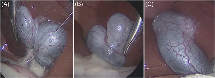 A double gallbladder was observed in 1 of the 52 cats in this study. Gallbladders (*) were found in the quadrate lobe and the medial right lobe, respectively (A). A 2‐lobed (heart‐shaped) gallbladder was observed in 7 of the 52 cats (B). A normal oval‐shaped gallbladder was observed in 44 of the 52 cats (C). The photographs show typical examples of each type