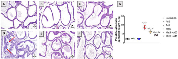 Impact of AM6545 and AM4113 treatment on prostate histopathology in MetS-induced BPH in rats. The MetS rats were treated with 10 mg/kg AM6545 or AM4113 daily for four weeks. Prostate sections stained with hematoxylin and eosin (H&E) are shown. (A) Control group showing the normal prostate histoarchitecture; (B) AM6545 (A65) and (C) AM4113 (A41) alone groups showed no observable histological changes; (D) MetS group showing hyperplasia with increased epithelial thickness; (E) MetS + AM6545 (MetS + A65) and (F) MetS + AM4113-treated (MetS + A41) groups showing a clear reduction in hyperplasia and projections; (G) Graphical display of prostate glandular epithelium height. Results are shown as mean ± S.D. (n ═ 8). P < 0.05 was considered statistically significant by one-way ANOVA with Tukey’s post hoc test. a, b, c, d, or e indicates a significant difference from the control, A65, A41, MetS, or MetS + A65 groups, respectively, at P < 0.05 employing one-way ANOVA followed by Tukey’s post hoc test. MetS: Metabolic syndrome; BPH: Benign prostatic hyperplasia; ANOVA: Analysis of variance; S.D.: Standard deviation.