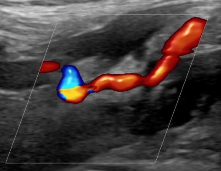 Left lower extremity arterial Doppler duplex ultrasound demonstrating severe atherosclerotic disease with occlusion of the mid and distal superficial femoral artery, popliteal artery, and dorsalis pedis artery