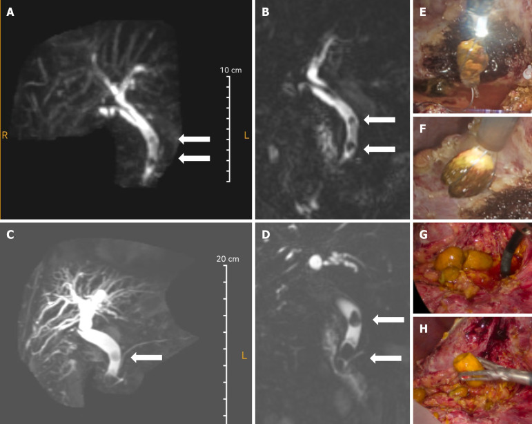 T2 coronal image shows bi-lobar central and peripheral intrahepatic biliary tract dilatation and dilated common bile duct with distal smooth tapering of common bile duct. White solid arrow: The filling defect.