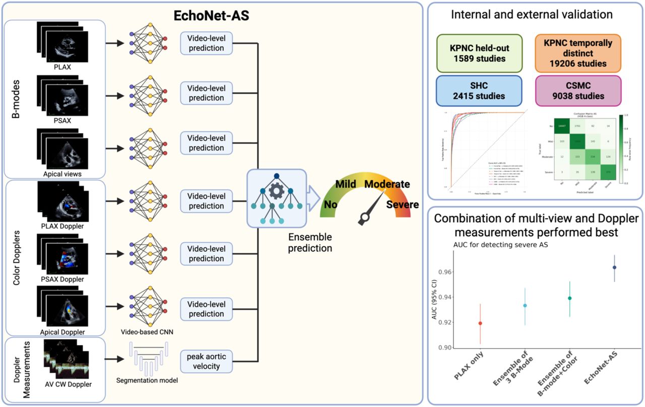 Overview of the study. In the EchoNet-AS framework, we trained video-based convolutional neural network (CNN) models to predict the severity of aortic stenosis (AS) from six distinct transthoracic echocardiographic views including both B-modes [parasternal long axis (PLAX), parasternal short axis (PSAX) and apical five/three chamber views] and Color dopplers [PLAX Doppler, PSAX Doppler and Apical Doppler]. In parallel, a segmentation model automatically measures peak aortic jet velocity. These outputs were integrated through an ensemble approach to generate a final prediction of AS severity. We evaluated the performance of this framework across four independent test datasets including held-out cohort and temporally distinct cohort from Kaiser Permanente Northern California (KPNC) and external validation cohort from Stanford Healthcare (SHC) and Cedars-Sinai Medical Center (CSMC). EchoNet-AS, which integrates B-modes, color Dopplers and Doppler measurements, showed superior performance compared to the single-view model or video only models. Created in https://BioRender.com