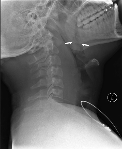 Lateral radiograph of the neck demonstrating a swollen uvula