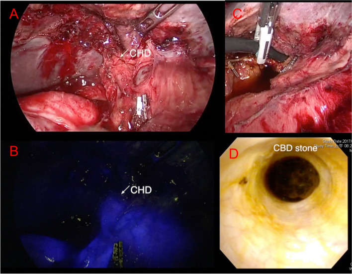 Fluorescent and white light imaging of biliary tree before choledochotomy. A Before choledochotomy, identification recording of the biliary tree using white light imaging: CBD upper margin (-), lower margin (-). B Fluorescent enhancement recording of the biliary tree using NIR image: CBD upper margin ( +), lower margin ( +). C Choledochoscope insertion into CBD. D CBD stone detection with choledochoscope