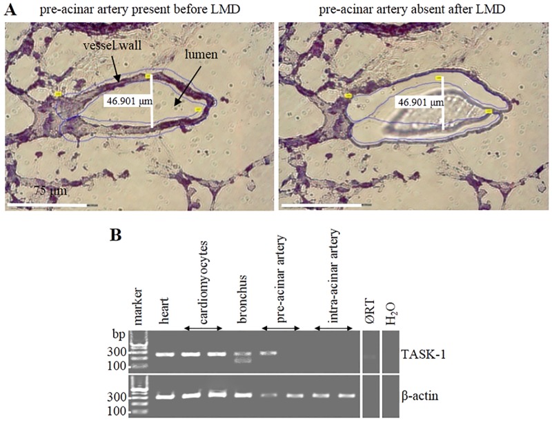 Laser-assisted Microdissection (LMD) and expression of TASK-1 in WT murine intra-pulmonary arteries.(A) LMD. The white line indicates the luminal diameter of a pre-acinar artery. It represents the maximum distance between intimal surfaces at right angle (90°) to the longitudinal axis. The area of vessel to be picked was first marked (blue lines; left panel). The marked piece of tissue (missing in right panel) was catapulted into the lid of a reaction tube and processed for RT-PCR. (B) RT-PCR of laser-assisted microdissected samples, agarose gel. ØRT is sample of cardiomyocytes processed without Reverse Transcriptase (RT). β-Actin was used as internal control. Heart served as positive control. H2O is control without cDNA template.