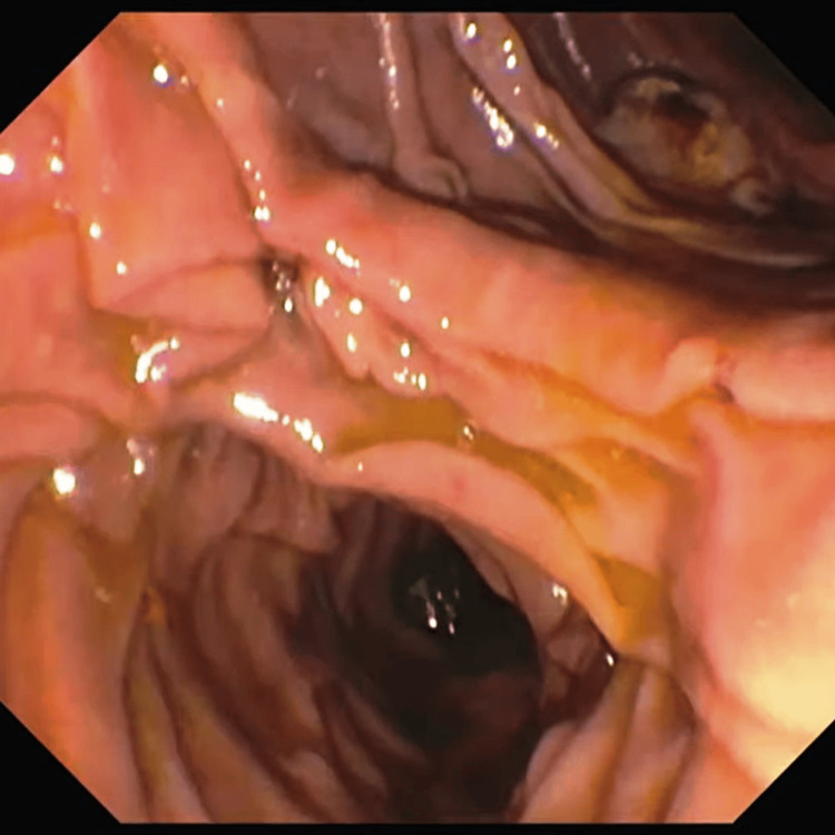 Extracted stone in the duodenum using ERCPERCP: endoscopic retrograde cholangiopancreatography