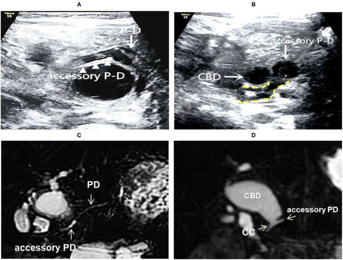 Images of a representative type C of PBM. (A) US transverses scan showing the main PD merging into the dilated accessory PD; (B) US transverse scan showing the terminal CBD and the accessory PD joining downward to form the common channel (shown by yellow dotted lines); (C) MRCP indicated the main PD imports to the accessary PD; (D) MRCP indicated the accessary PD joins with the distal CBD to form the common channel, suggesting a type D.