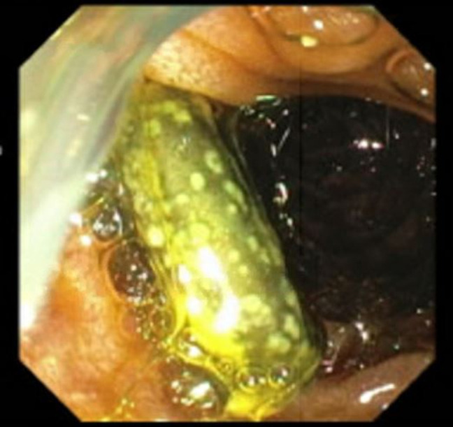 Endoscopic retrograde cholangiopancreatography showing an occluded stent at the major duodenal papilla.