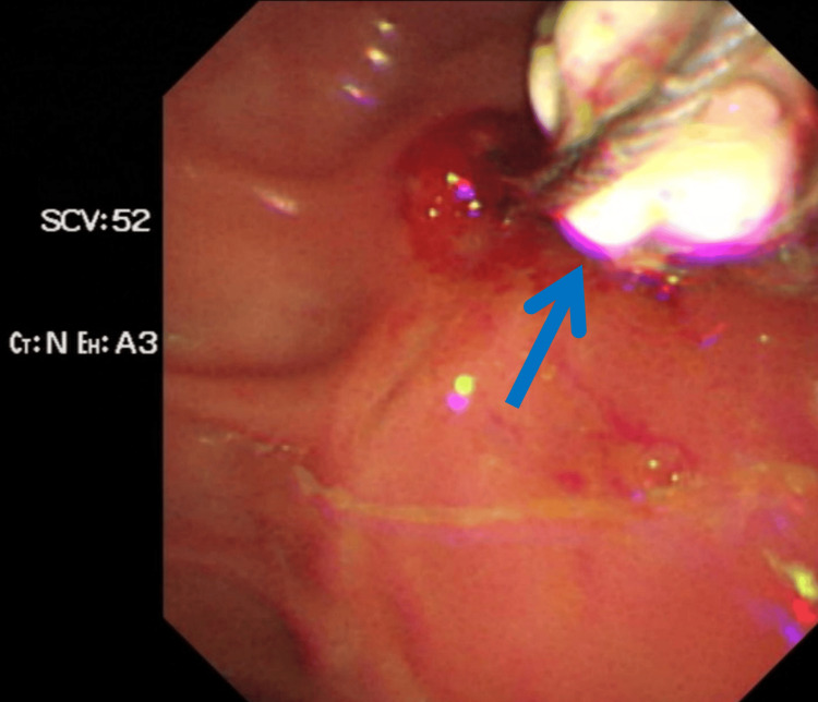 Stone extracted during endoscopic retrograde cholangiopancreatography.The arrow in the figure indicates the removed calculus, which is approximately 1.7 × 1.5 cm in size, white in color, and with a hard texture.