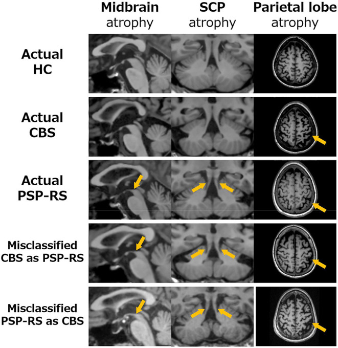 Comparison the brain atrophy in midbrain (left), SCP (middle) and parietal lobe (right) among classified patients into CBS and PSP-RS by the SuStaIn. In patients with CBS misclassified as PSP-RS (4th raw), the atrophies of the midbrain (1st column) and SCP (2nd column) were similar to PSP-RS (3rd raw), in which atrophy of the midbrain and SCP is severe (orange arrows). Furthermore, atrophy of the parietal lobe (3rd column), which is typically severe in CBS, in patients with CBS misclassified as PSP-RS was much weaker than that in correctly classified CBS and very close to that in correctly classified PSP-RS (orange arrows) patients. Similarly, patients with PSP-RS misclassified as CBS (5th raw) resembled the atrophy characters of patients with CBS (2nd raw) and the parietal lobe in patients with PSP-RS misclassified as CBS was much stronger than that in correctly classified PSP-RS.