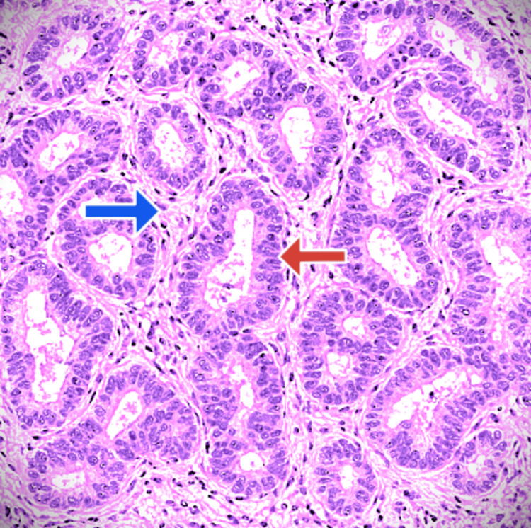 Pancreatic adenocarcinoma, EUS-FNA histology (H&E stain)EUS-FNA: endoscopic ultrasound-guided fine needle aspiration; H&E: hematoxylin and eosinThe red arrow shows the malignant glandular structure; the blue arrow shows the desmoplastic stroma around these glands.