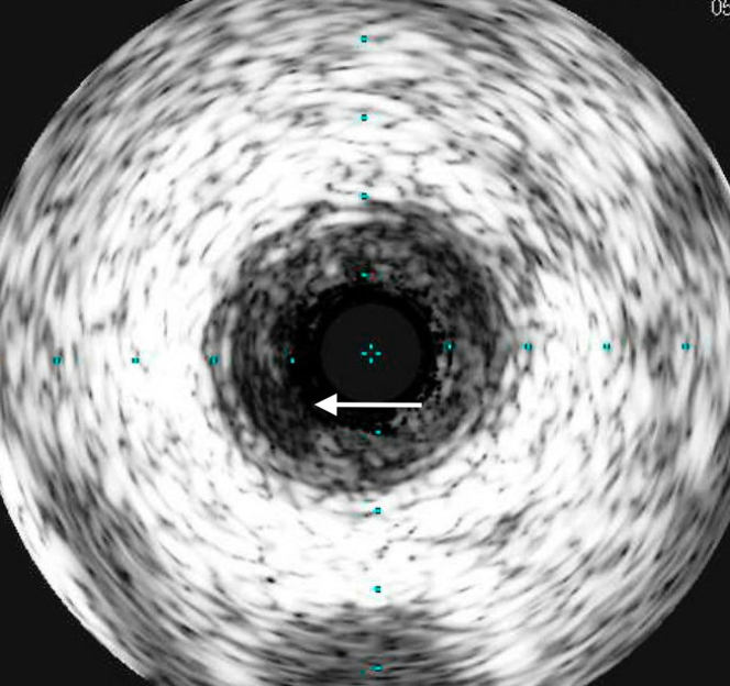 Intravascular UltrasoundIntravascular ultrasound demonstrated a left anterior descending coronary artery free of any atherosclerosis except a very short segment, approximately 10 mm long, in the proximal segment with ruptured plaque (white arrow).