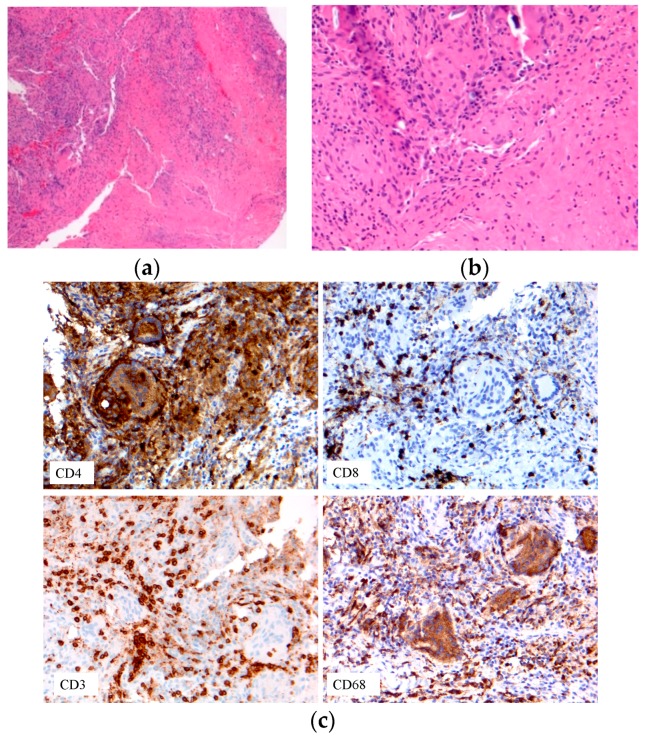 Immune cell phenotypes: T-cells: CD3, CD4, CD8; macrophage CD68. (a) Early onset sarcoidosis (EOS) skin sarcoidosis; (b–c) EOS skin sarcoidosis.