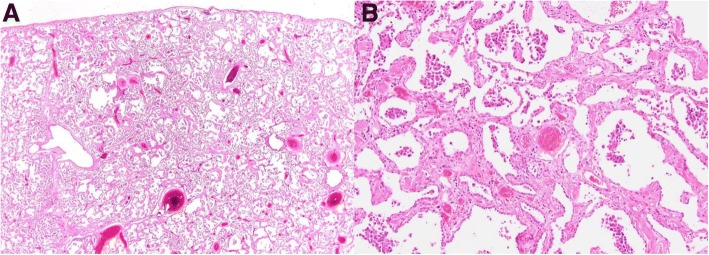 10× (a) and 100× (b) views of the explanted lungs. The number of airspace macrophages has considerably decreased compared to the surgical lung biopsy, and the process more closely resembles fibrotic non-specific interstitial pneumonia than desquamative interstitial pneumonia