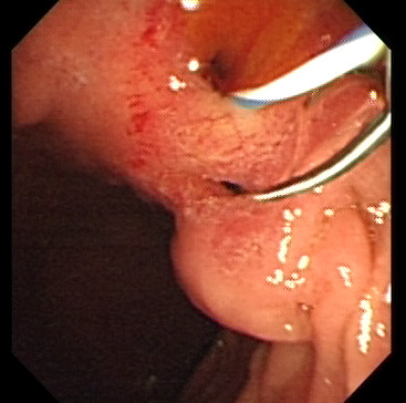 Endosopic view of the opening site of CBD in the duodenal bulb. Slit – like ectopic openings of common bile duct (upper hole) and pancreatic duct (lower hole) with guide-wires inserted for the better demonstration.