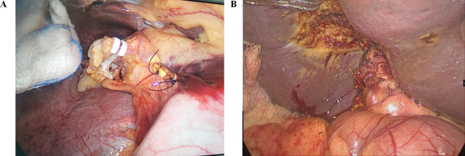 A: A representative image demonstrating laparoscopic common bile duct exploration via the common bile duct with primary closure. B: A representative image demonstrating laparoscopic common bile duct exploration via the cystic duct with primary closure