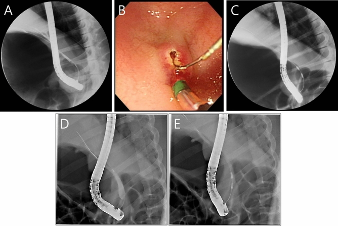 Endoscopic retrograde cholangiography examination of a miniature pig during endobiliary RFA. (A) Cholangiogram shows non-dilated CBD before endobiliary RFA. (B) Endoscopic biliary sphincterotomy. (C) Fluoroscopic examination shows the RFA catheter positioned in the distal CBD while performing RFA. (D) and (E) Fluoroscopic views show the suction technique as in vacuum evacuation to maximize the contact between the CBD mucosa and the RFA catheter, even if the CBD was dilated.
