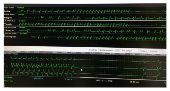 Third-degree atrioventricular block. During observation at the emergency department, multiple episodes of third-degree atrioventricular block were noted, the longest of which lasted 7.2 s (arrow).