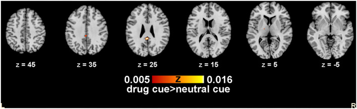 Co-activated clusters about alcohol, nicotine, and illegal drugs. Slices taken at X = 0; Y = −18.