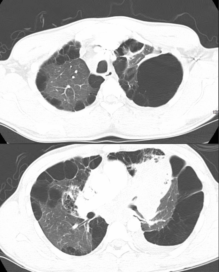 Pulmonary CTA performed due to suspicion of pulmonary embolism did not show evidence of pulmonary embolism, no significant interval change in the size of the large left upper lobe mass and associated consolidation, and severe bilateral bullous emphysema.CTA: computed tomography angiography