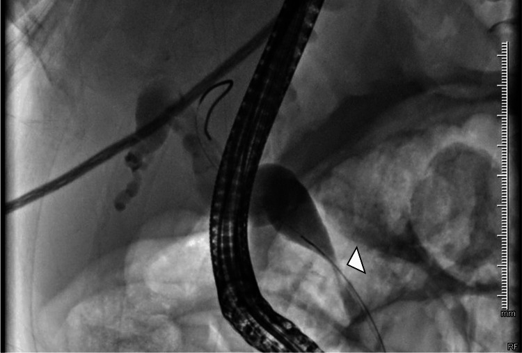 ERCP image showing distal common bile duct stricture (arrowhead)ERCP: endoscopic retrograde cholangiopancreatography