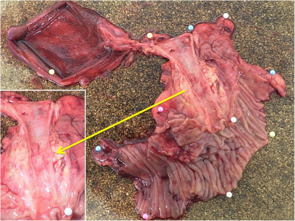 Macroscopic examinations of tumors usually reveal a nodular, infiltrating, or polypoid mass (arrow)