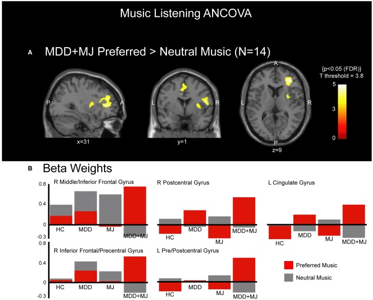 ANCOVA post hoc. (A) shows clusters of activated voxels, which had significantly more activation for preferred compared with neutral music in the MDD + MJ group in the sagittal, coronal, and transverse perspectives overlaid on a normalized T1-weighted anatomical image at MNI planes indicated. P = posterior, A = anterior, L = left, R = right. No other post hoc comparisons met statistical correction. (B) shows the beta weights associated with each identified cluster that met statistical significance, separated by music type and by group.
