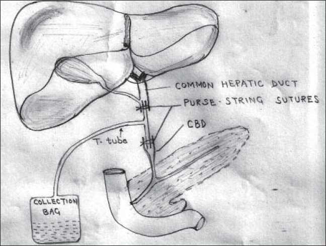 Diagrammatic representation of our T-tube placement technique