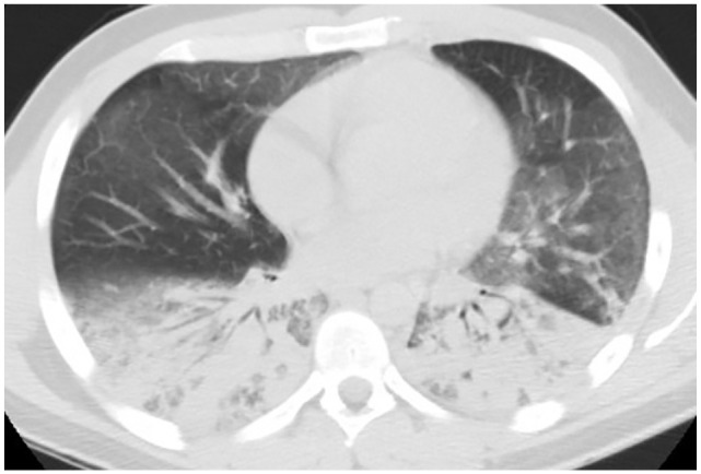 Mild ground glass opacities to upper lobe with bilateral lower lobe dense consolidations.
