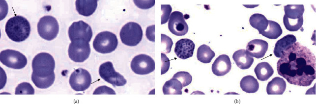 (a, b) Peripheral blood smear with basophilic stippling of red blood cells (arrows) (Wright–Giemsa, ×1000).
