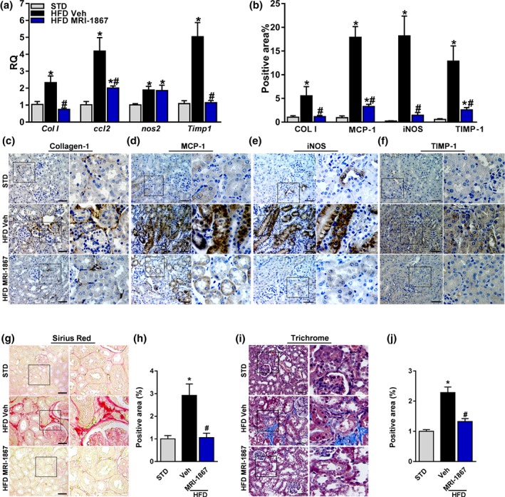 MRI‐1867 improves renal inflammation and fibrosis in diet‐induced obese mice. Mice on standard diet (STD) or high‐fat diet (HFD) for 18 weeks were treated with vehicle (Veh) or MRI‐1867 (3 mg·kg−1) orally for 28 days. The HFD‐induced up‐regulation in the renal mRNA and/or the protein expression levels of (a–c) collagen‐1, (a, b, d) CCL2, (a, b, e) inducible NOS (iNOS), and (a, b, f) tissue inhibitor of metalloproteinase 1 (TIMP‐1) were attenuated or normalized in the MRI‐1867‐treated DIO mice. Similarly, the elevated collagen deposition in Veh‐treated DIO mice, measured by (g, h) Sirius Red staining and (i, j) Masson's trichrome staining, was reversed by chronic MRI‐1867 treatment. Scale bar, 20 μm. RQ, relative quantitation. Data represent the mean ± SEM from 8 to 14 mice per group. * P < .05, significantly different from animals on STD; # P < .05, significantly different from animals on the same diet; one‐way ANOVA, followed by a Bonferroni post hoc test