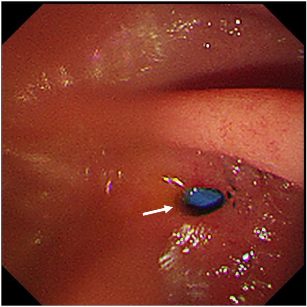 Endoscopic photograph captured via duodenoscopy during scope withdrawal. The image provides a clear close-up view of the mucosal lining of the proximal descending duodenum. A white arrow distinctly indicates a 5-mm fistula orifice within the gastrointestinal tissue, with normal surrounding mucosal architecture visible for anatomical and clinical reference.