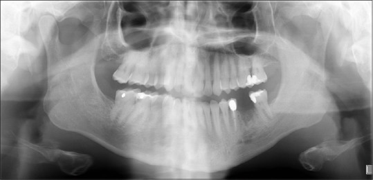Patient A. Two-month follow-up, nonhealing extraction site of #19